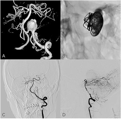 Treatment of Unruptured Vertebral Artery Aneurysm Involving Posterior Inferior Cerebellar Artery With Pipeline Embolization Device